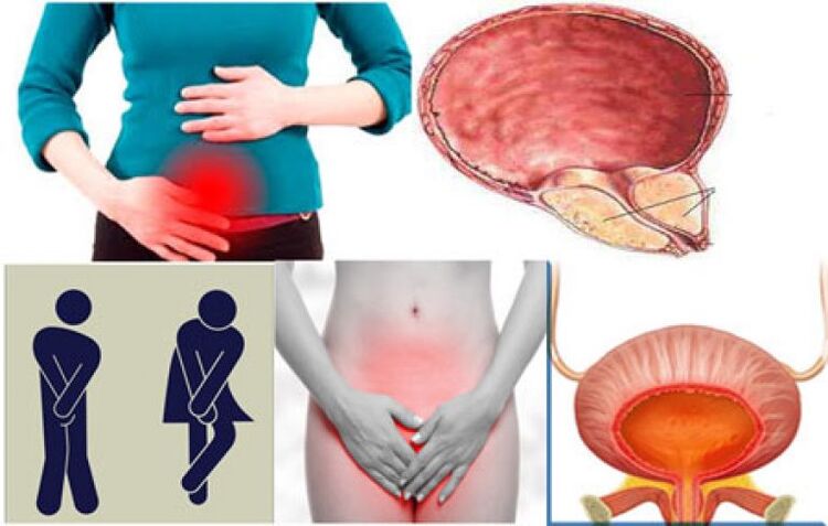 Signs of cystitis in women burning and pain during urination